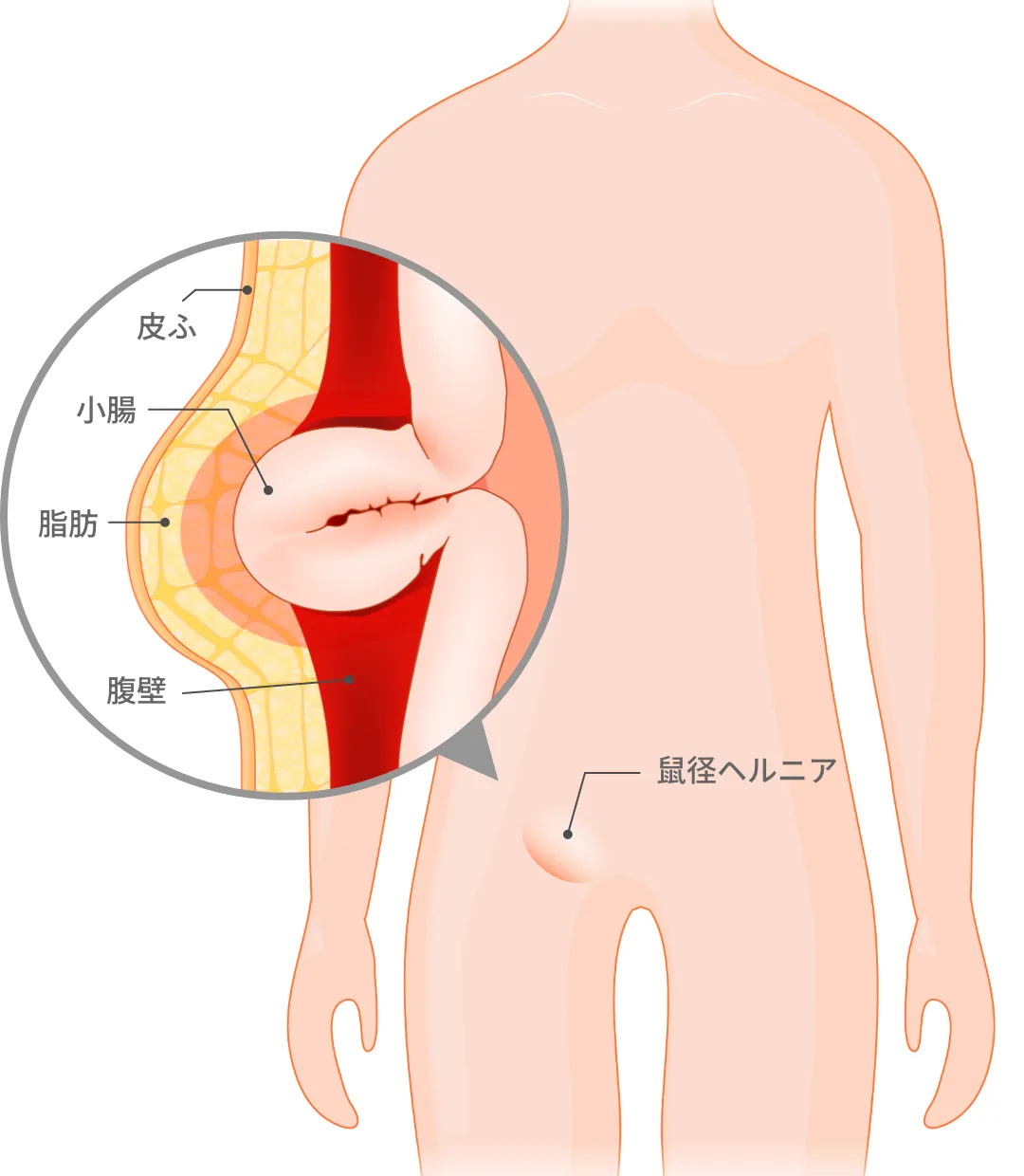 鼠径ヘルニア(脱腸)の状態のイラスト